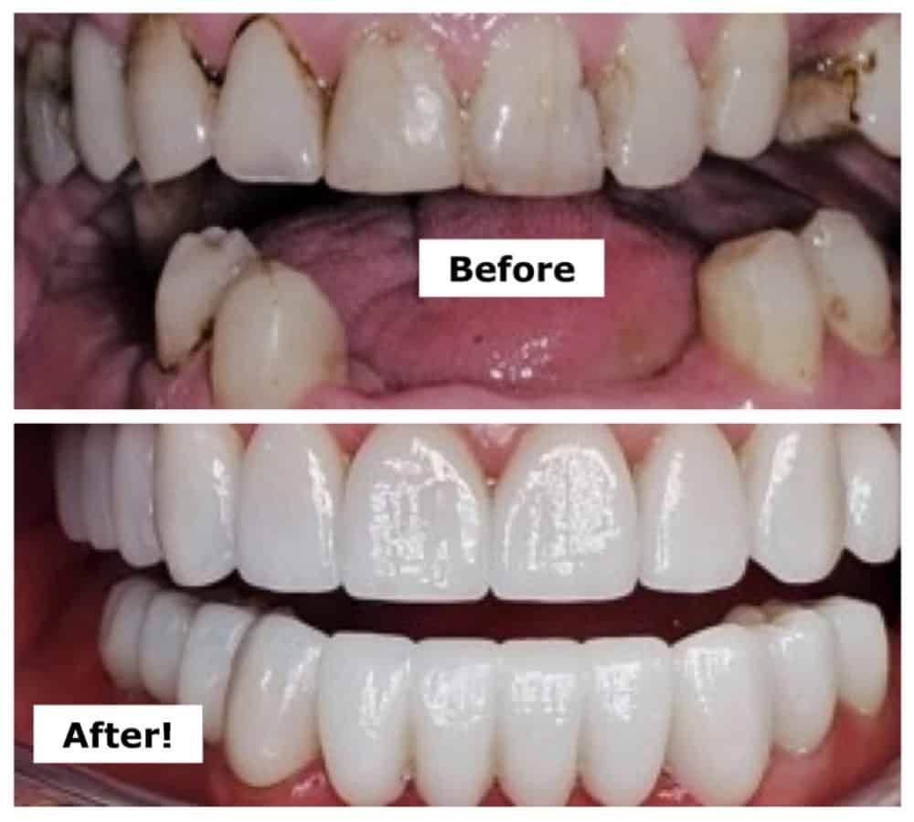 Cosmetic Dental Treatments for Oral Cancer
