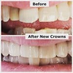 Dental crowns fixed Felix's smile