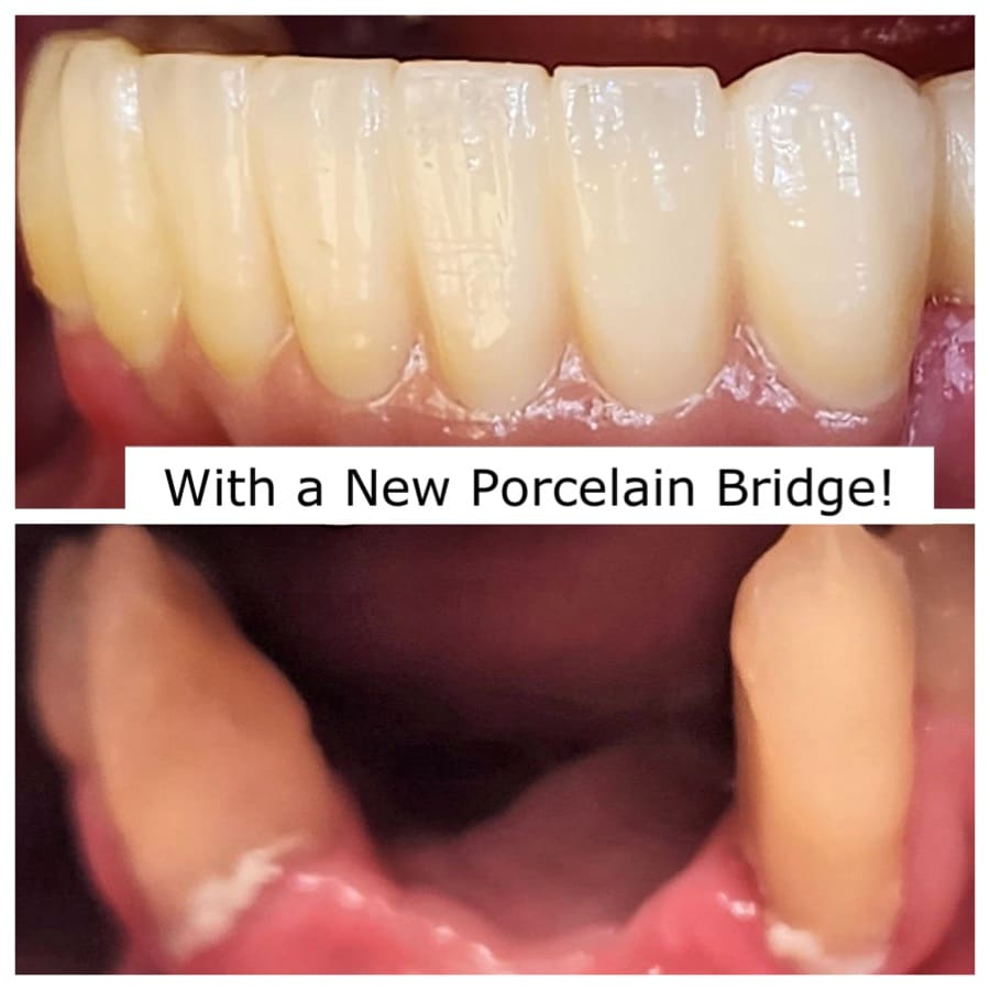 A Porcelain Bridge Completes A Smile Beffa Dental Burien WA A Porcelain Bridge Completes A Smile Beffa Dental Burien WA