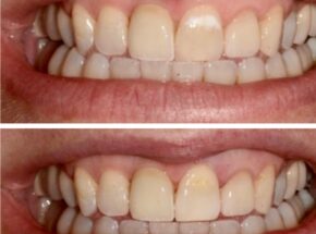 White spots be gone from your teeth!
