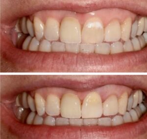 White spots be gone from your teeth!
