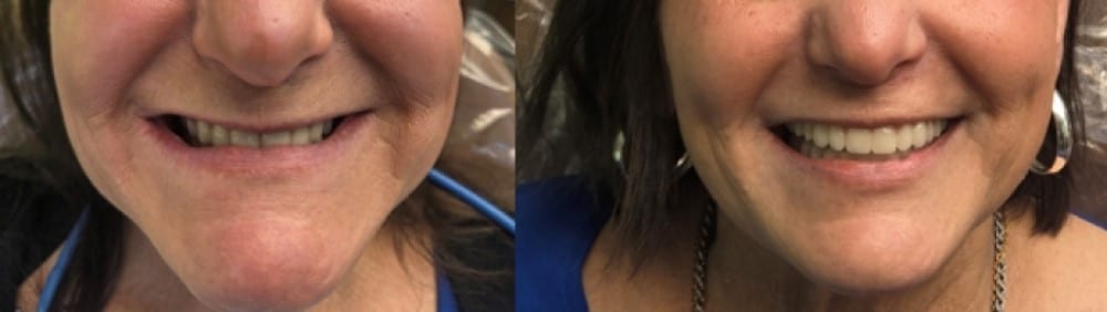 Denture Replacements for Burien