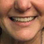 After Photo of Denture Replacement