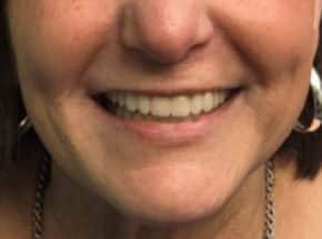 After Photo of Denture Replacement