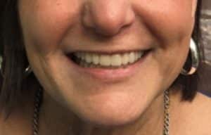 After Photo of Denture Replacement
