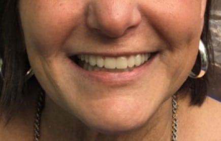 After Photo of Denture Replacement