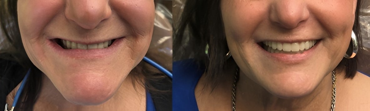 Denture Replacement Before and After